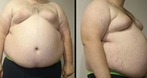 Doctors Barred From Treating Obese Man Who Identifies As Thin
