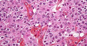 Surgeons Rescue Tumor From Brain Of Malignant Palestine Activist